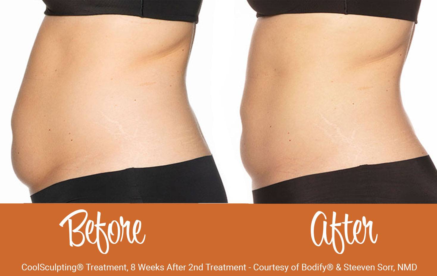 Before and after CoolSculpting® Treatment