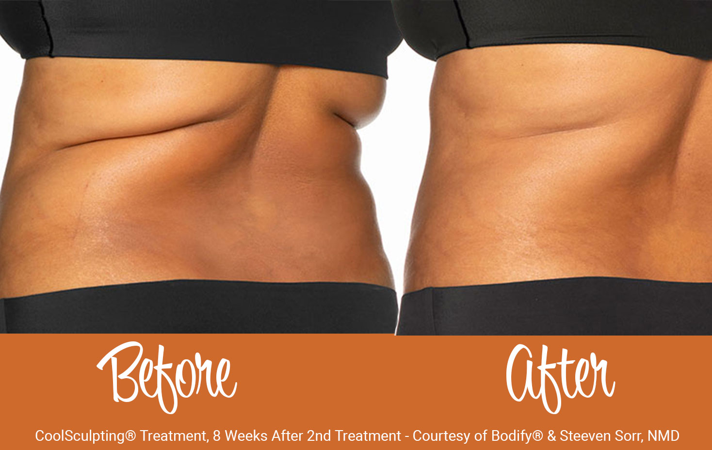 Before and after CoolSculpting® treatment on back