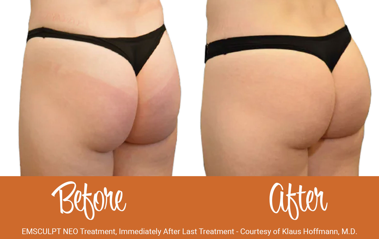 EMSCULPT NEO before and after glutes