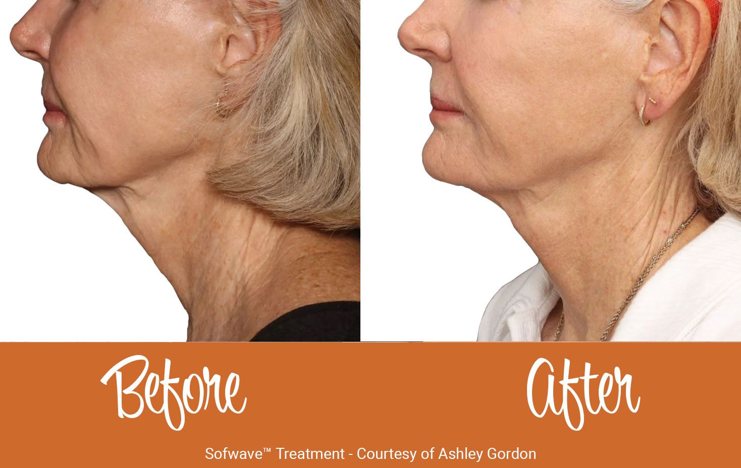 Before and after of Sofwave™ Wrinkle Reduction on submental.